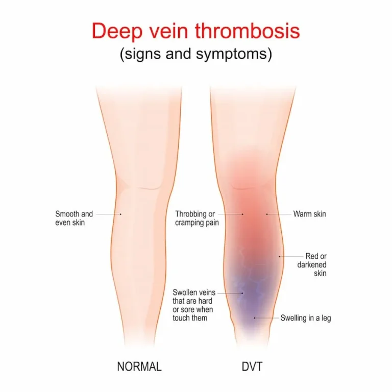 Diagram comparing normal leg and symptoms of deep vein thrombosis.