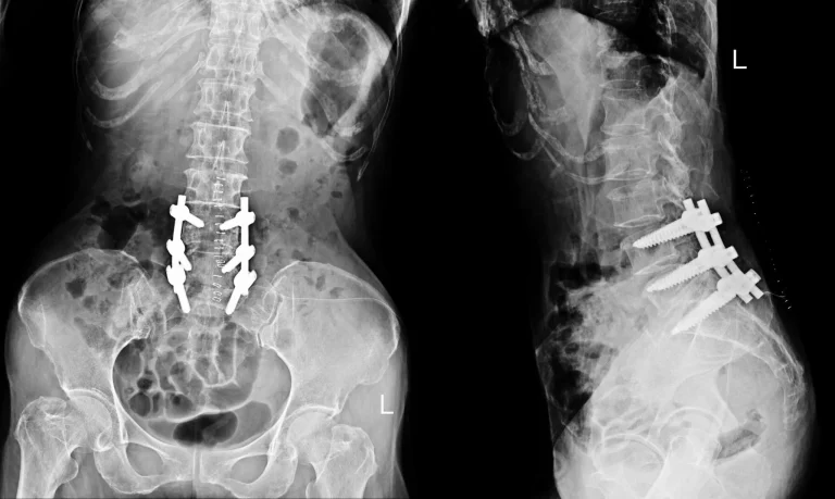 X-ray showing spinal hardware in the lower back from front and side views.