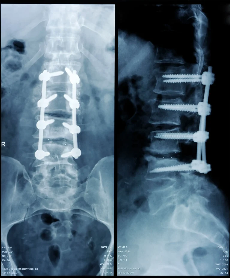 X-ray showing spinal fusion with screws and rods from front and side views.