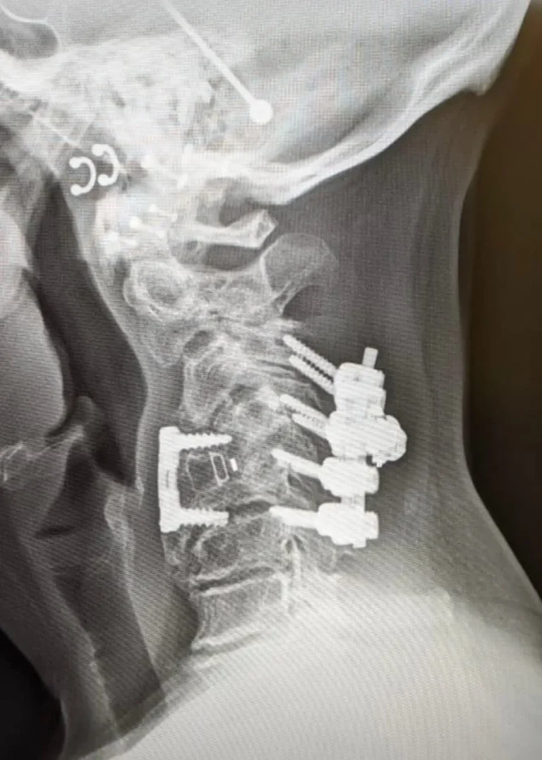 X-ray of a neck showing surgical hardware and screws in the cervical spine.