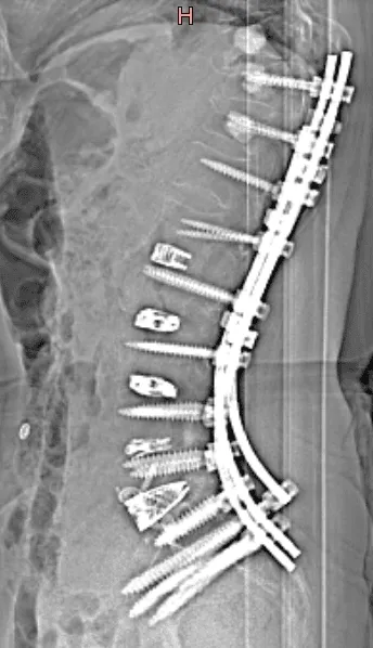 X-ray of a spine with surgical rods and screws implanted along the vertebrae.