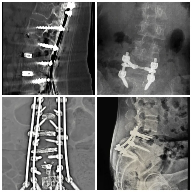 X-rays of spinal surgeries showing metal screws and rods in the spine.