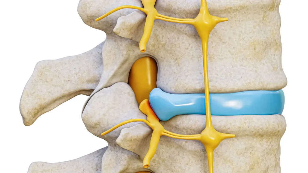 Illustration of a herniated disc pressing on adjacent spinal nerves.