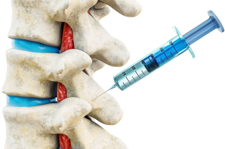 Diagram of a syringe injecting between vertebrae in a spine model.