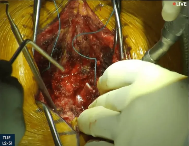 Surgical procedure on the spine using instruments and gloves.