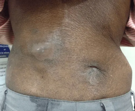 A person's lower back with a large blister and several scars visible.