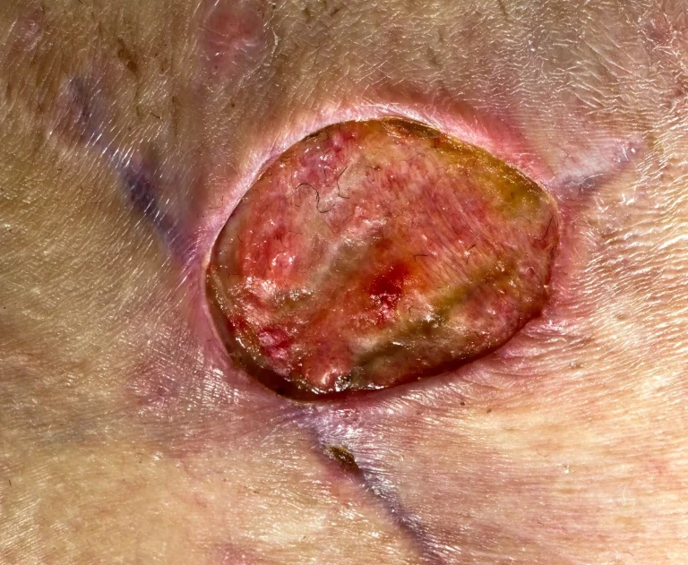 Close-up of a red, oval-shaped ulcer on human skin with irregular edges.