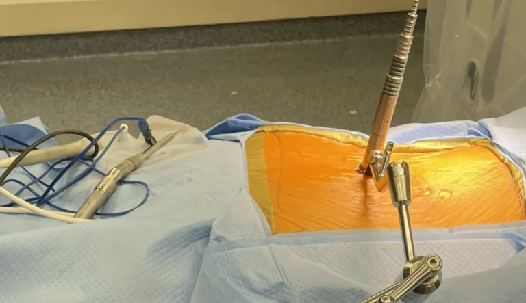 Surgical setup with tools surrounding an incision site covered in iodine and blue drapes.