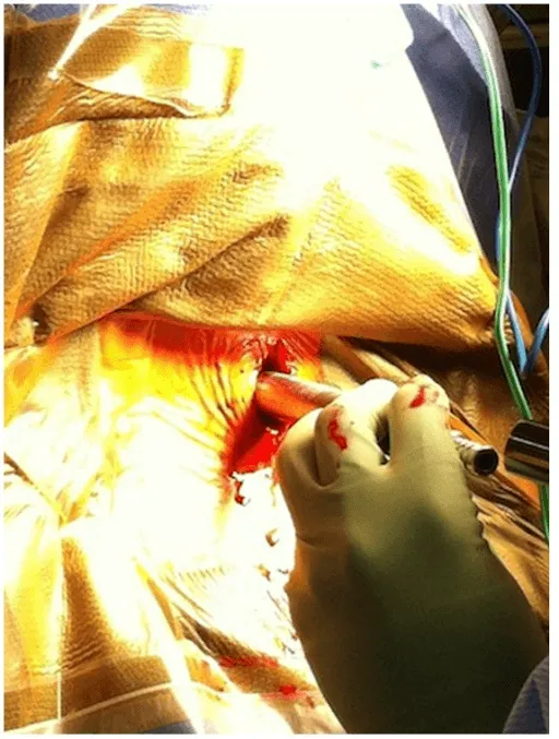 A gloved hand performing surgical incision on a patient with blood visible.