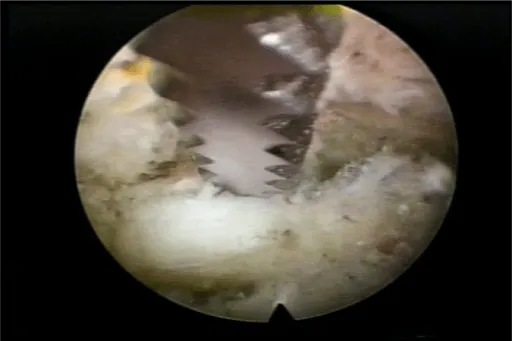 Close-up of arthroscopic knee surgery showing a surgical tool inside a joint.