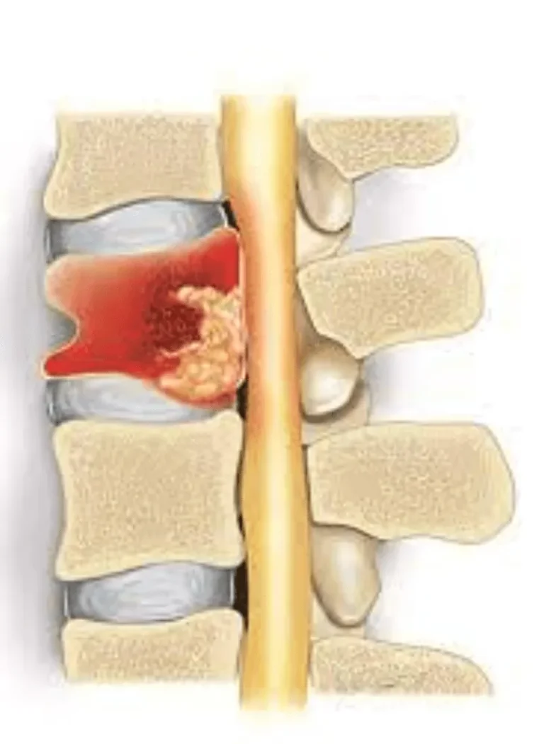 Illustration of a herniated disc pressing against spinal nerves.