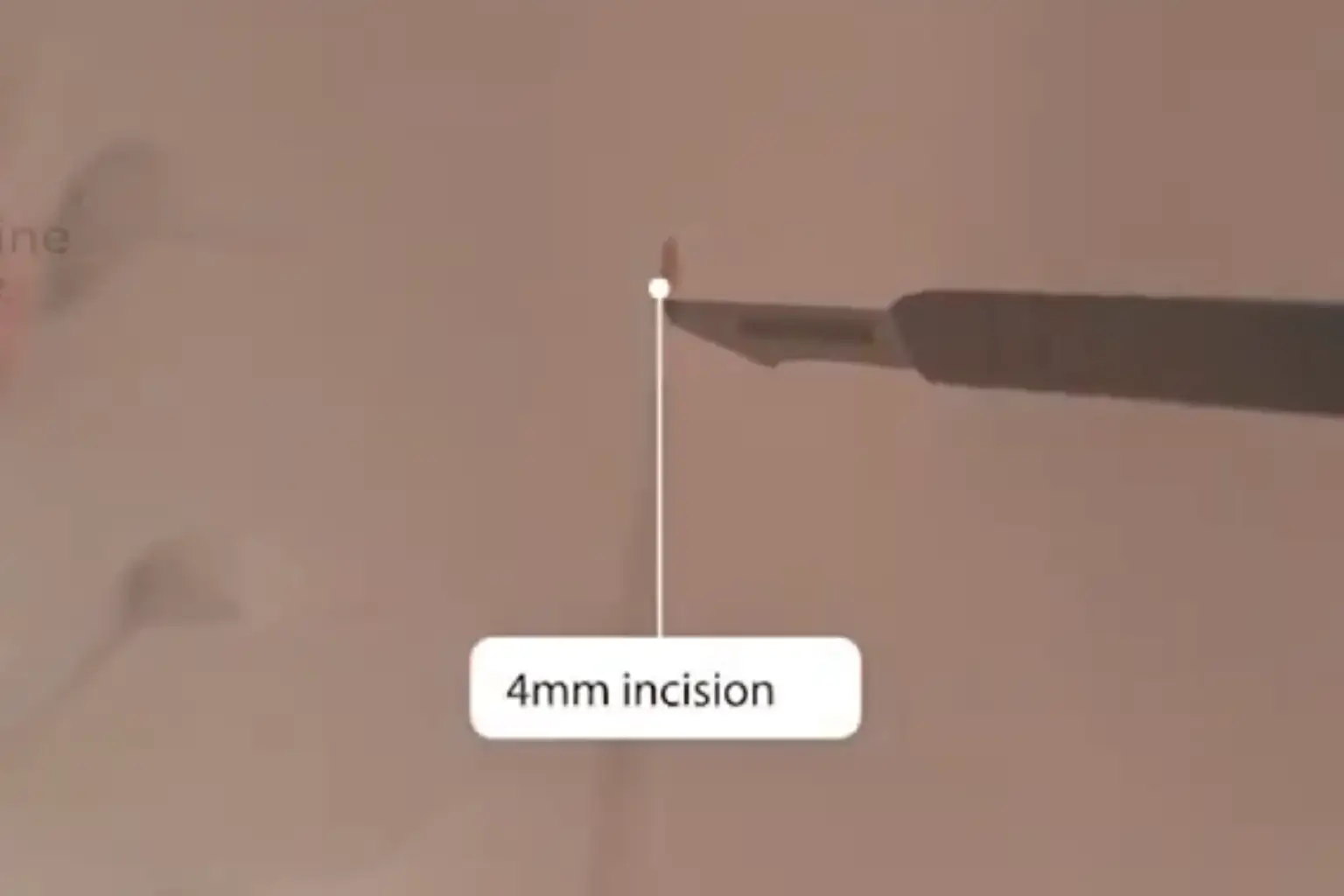 Scalpel next to a marked 4mm incision line on skin.