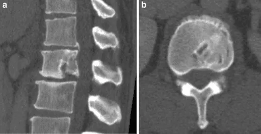 CT scans showing a spine fracture in sagittal (a) and axial (b) views.
