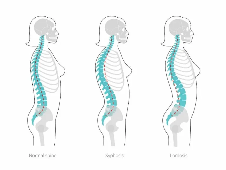 Illustration comparing normal spine, kyphosis, and lordosis curvature in side view.