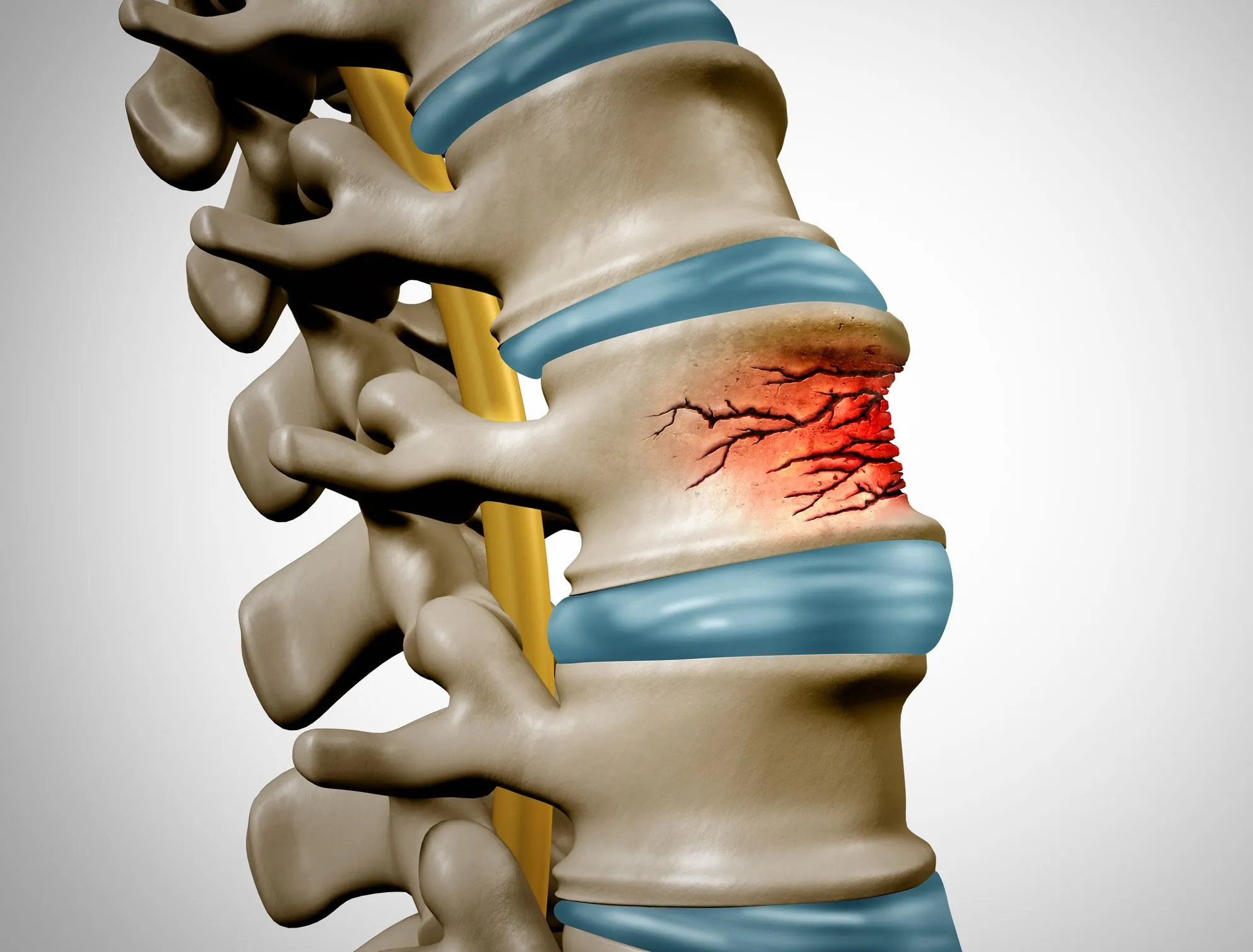 3D medical illustration showing a vertebral fracture in a spinal column, highlighting potential complications that occur with total disc replacement surgery. 