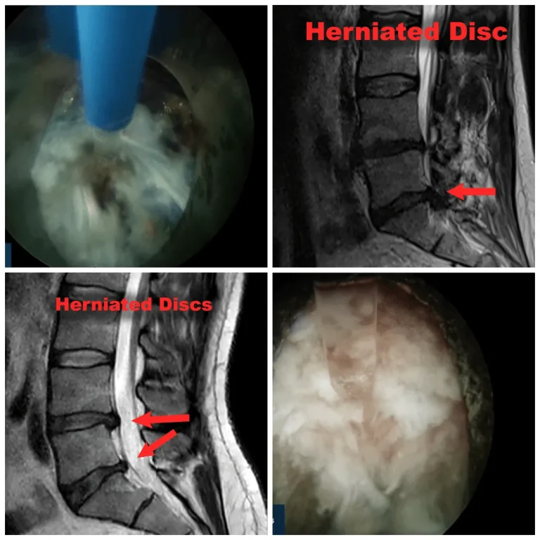 MRI and endoscopic images showing herniated discs with arrows indicating affected areas.
