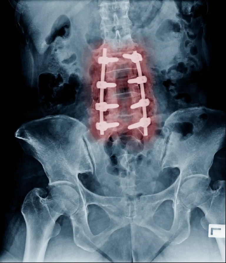 X-ray of a spine with red-highlighted spinal fusion hardware.
