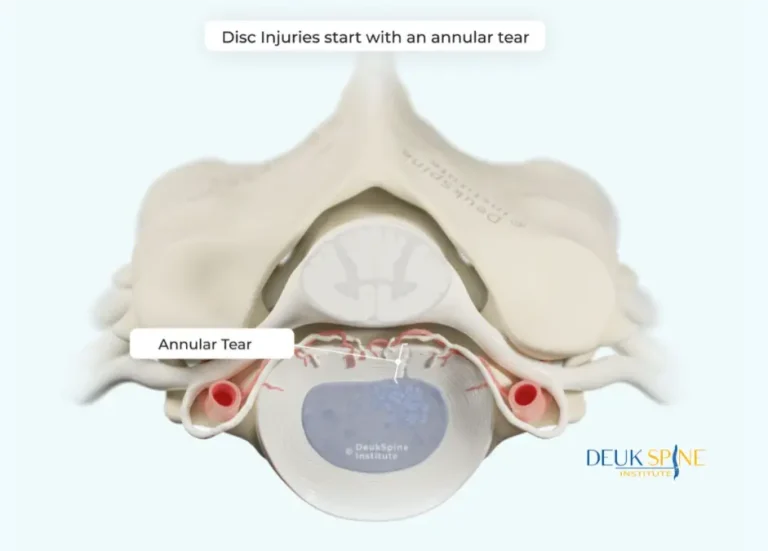 Annular Tear Diagram showing an annular tear in a spinal disc with labels.