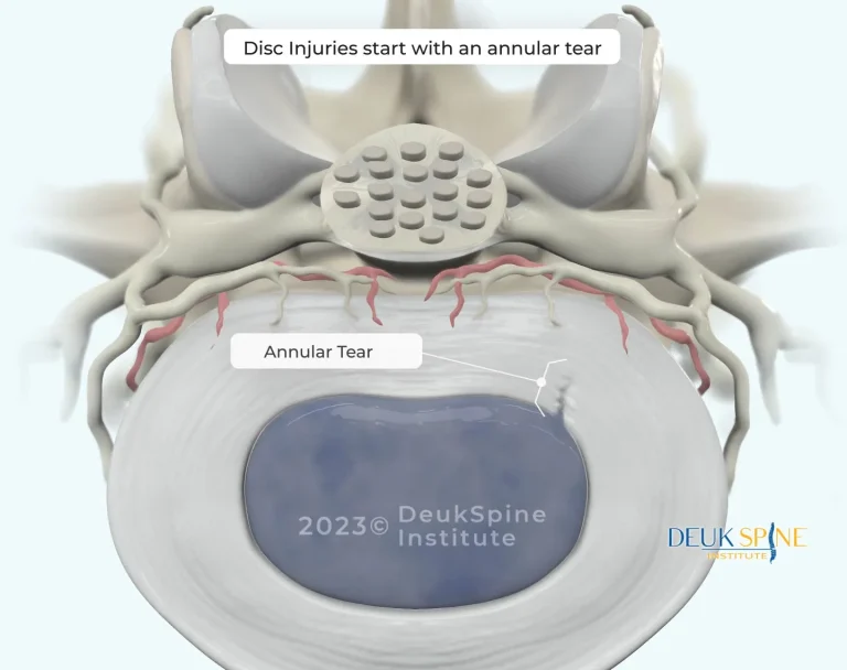 Close-up diagram of a spinal disc showing an annular tear labeled.