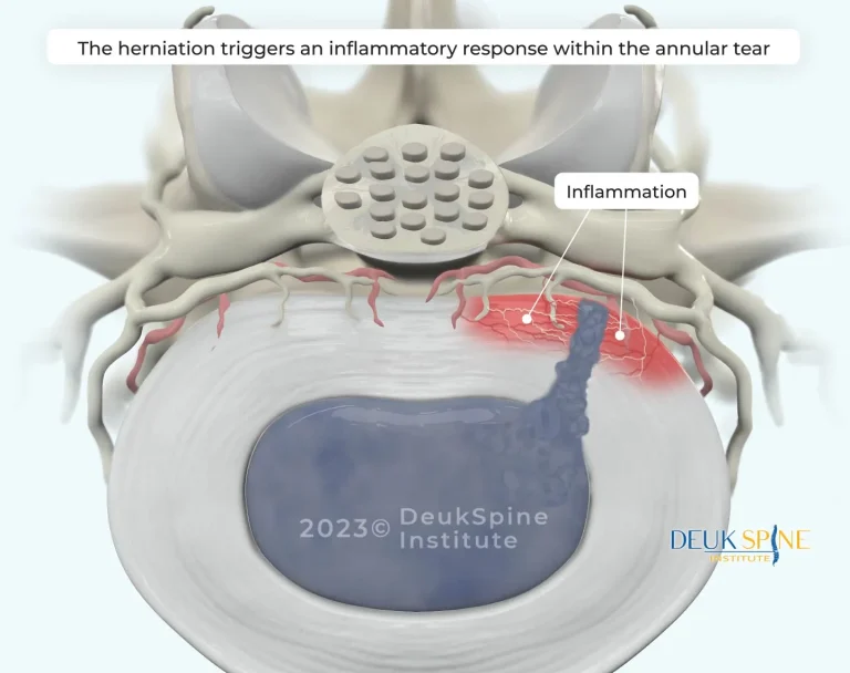 Illustration of a spinal disc herniation causing inflammation at the annular tear.