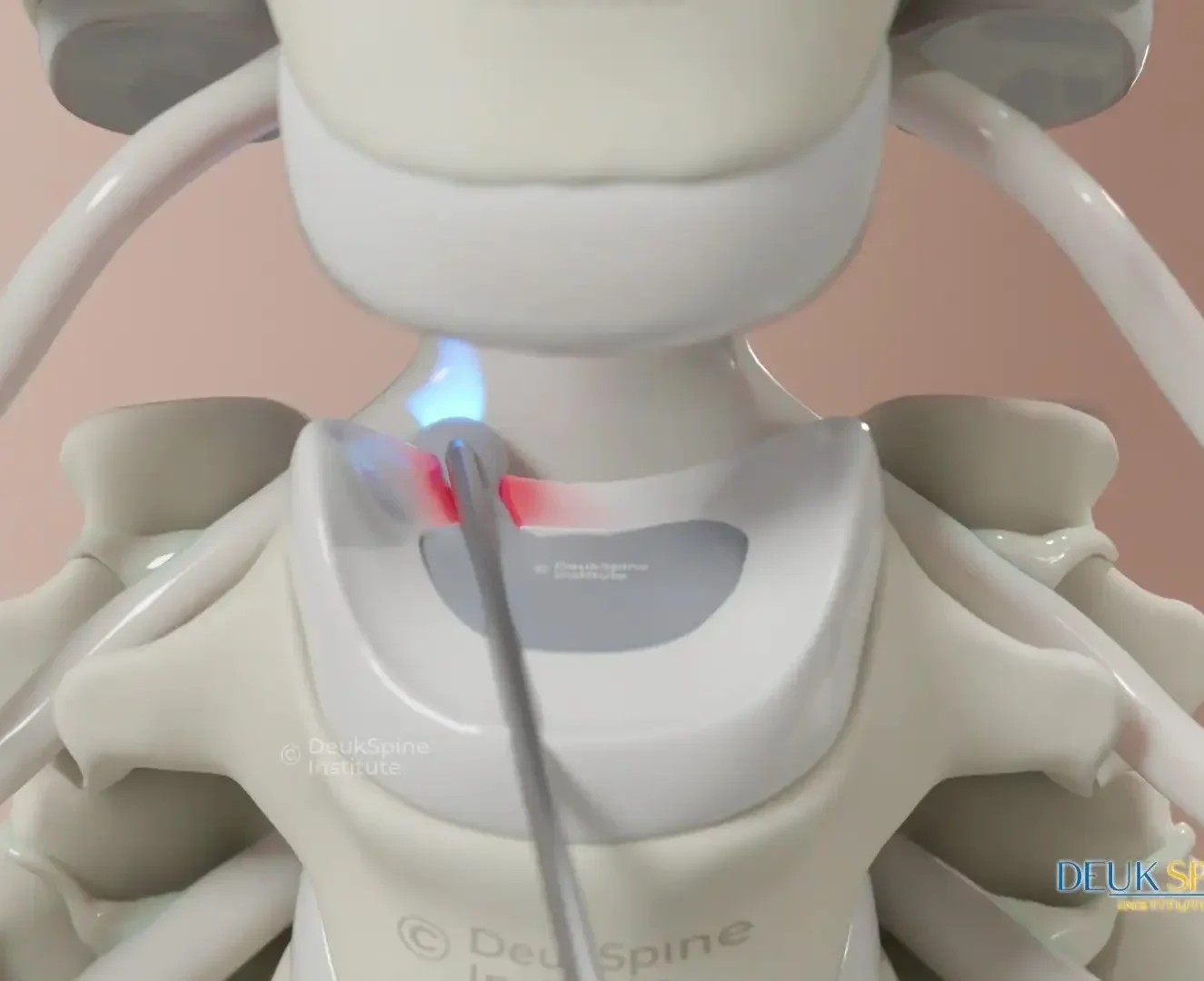 Benefits of Cervical Deuk Laser Disc Repair