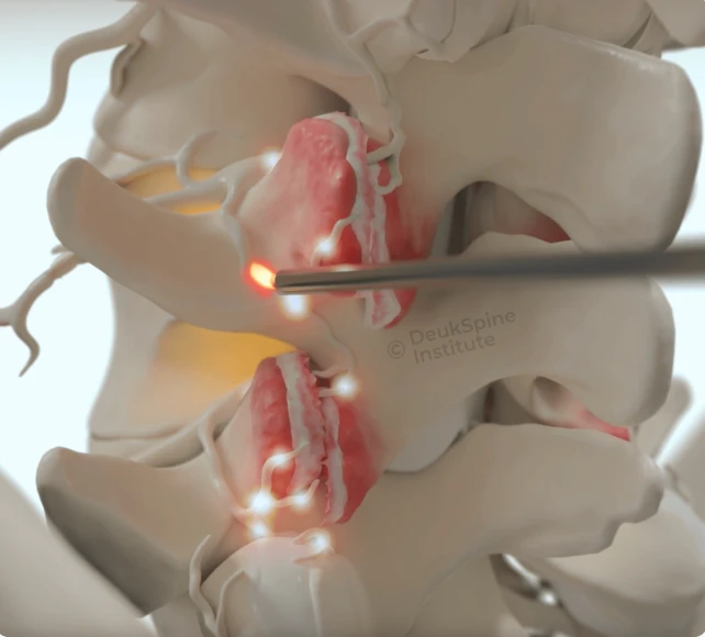 Benefits of Lumbar Deuk Plasma Rhizotomy