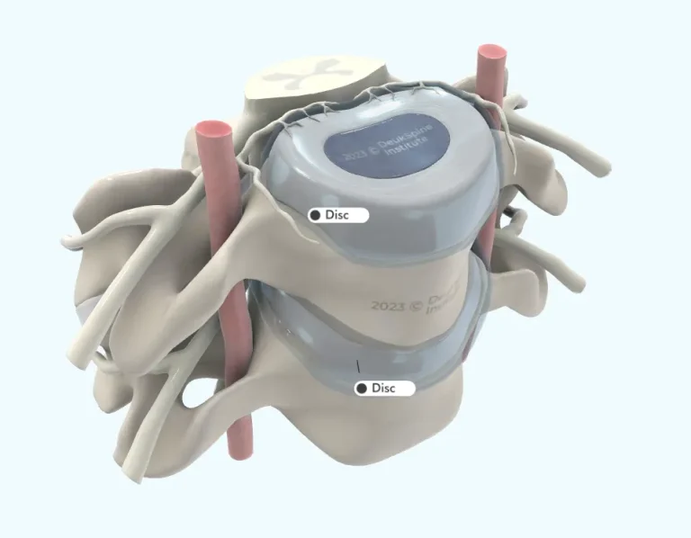 D model of spinal vertebrae with intervertebral discs labeled.