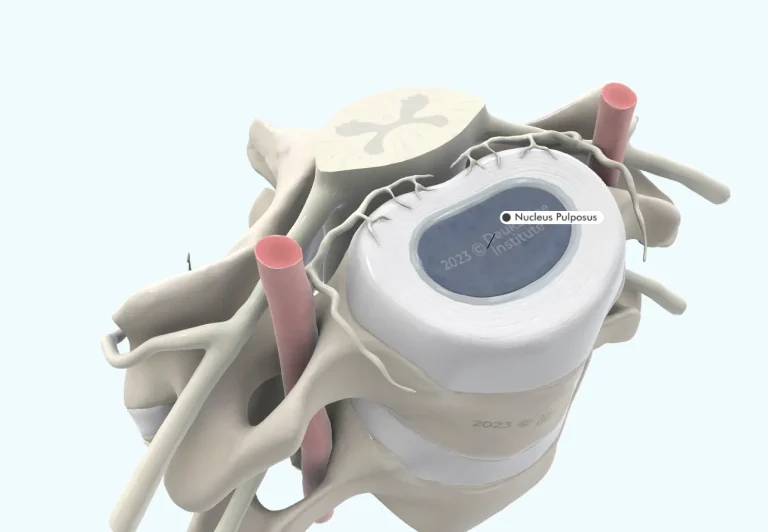 D anatomical model showing a vertebral disc with labeled nucleus pulposus.