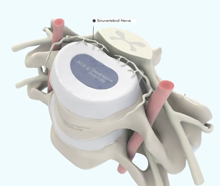 D model of a vertebra showing the sinuvertebral nerve and surrounding structures.