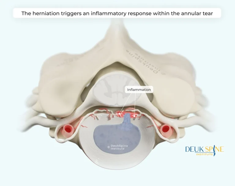 Illustration showing spinal disc herniation causing inflammation in an annular tear.