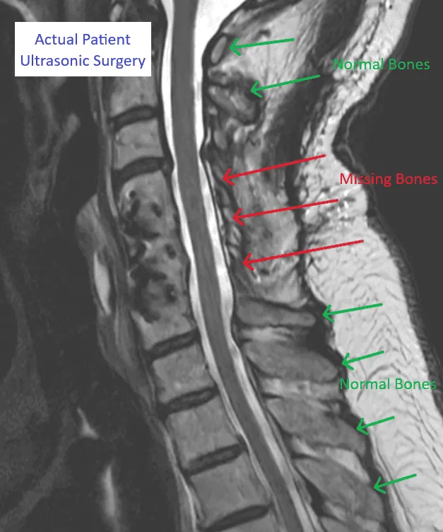 MRI image of a spine showing areas with normal and missing bones labeled in green and red.