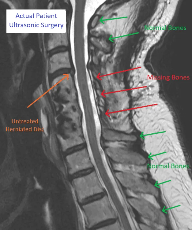 Medical scan showing normal and missing spinal bones with herniated disc, labeled for ultrasonic surgery.