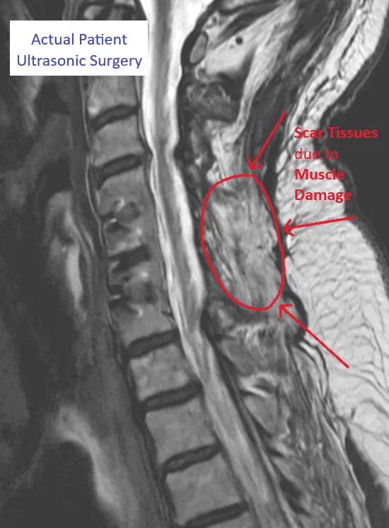 MRI showing spinal structure with labeled scar tissue from muscle damage.