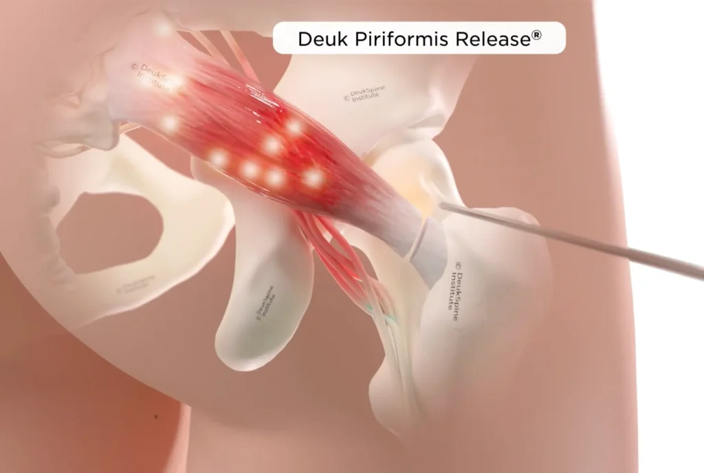 Illustration of Deuk Piriformis Release procedure showing targeted muscle and surrounding anatomy.