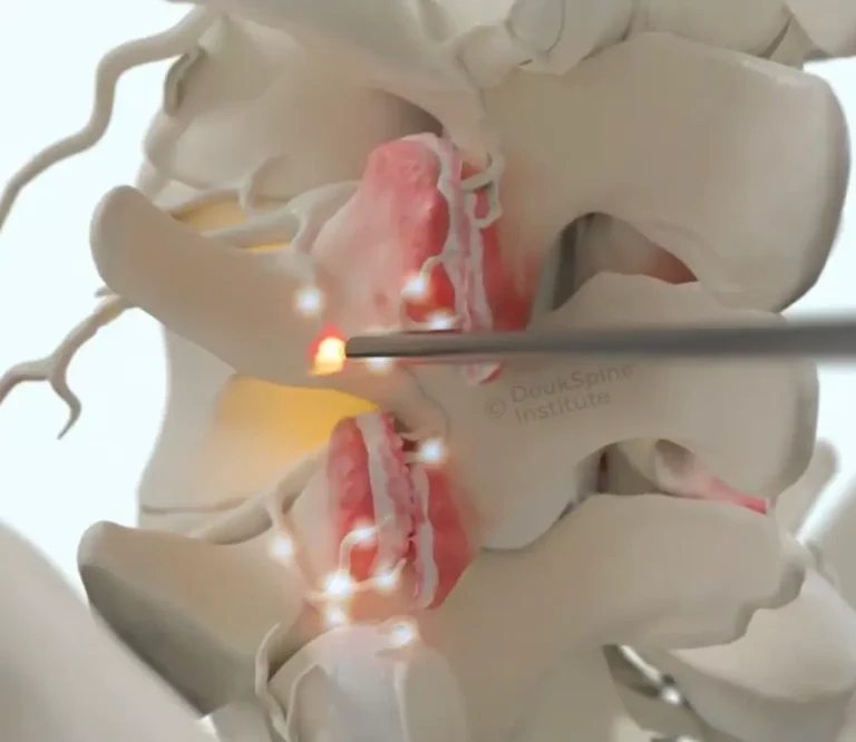 Deuk Plasma Rhizotomy A medical illustration of a spinal procedure using a laser on a highlighted disc.