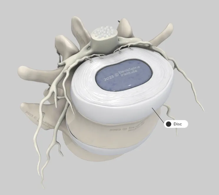 D model of a spinal disc with highlighted structures and surrounding nerves.