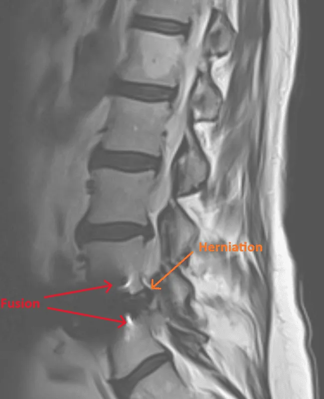 MRI of the spine showing herniation and fusion marked with arrows.