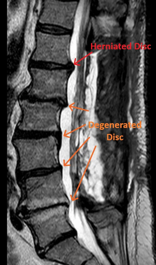 MRI scan of a spine showing labeled herniated and degenerated discs.