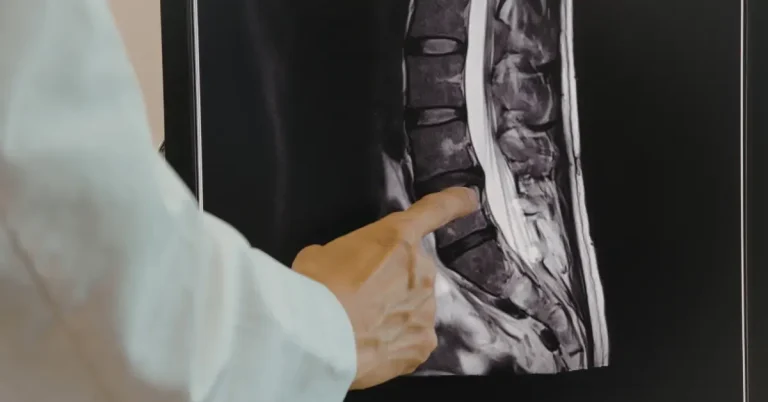 A doctor pointing to a lumbar spine MRI scan to assess spinal conditions and determine candidacy for spinal fusion surgery