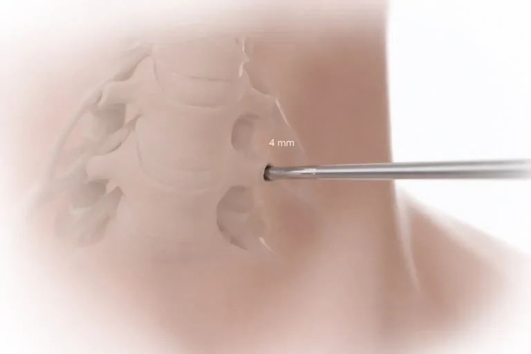 A surgical instrument inserts into a vertebra with a 4mm label.