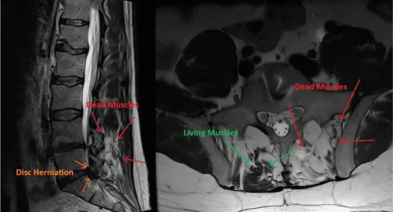 MRI showing disc herniation and muscle condition with labeled dead and living muscles.