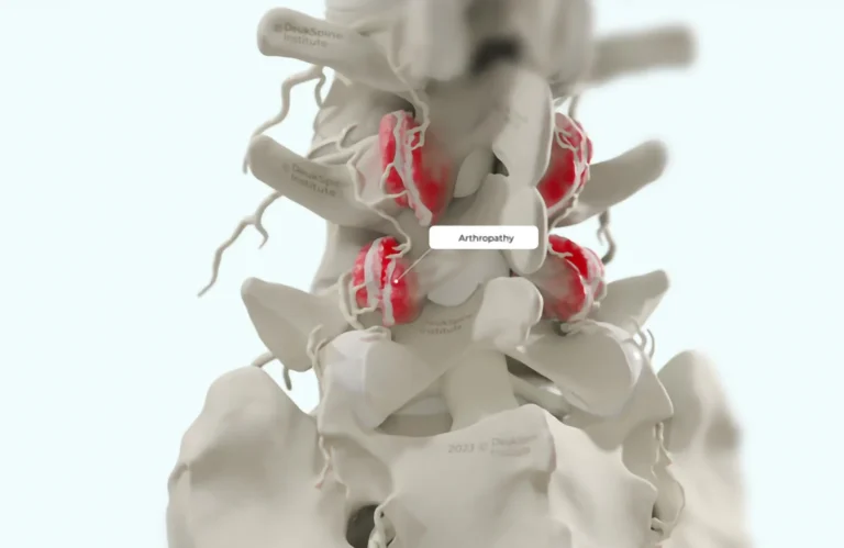 D spine model showing red-highlighted areas labeled "Arthropathy" on vertebrae.