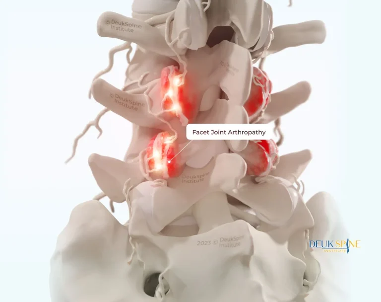 Illustration of spine showing inflamed facet joints with the label "Facet Joint Arthropathy.