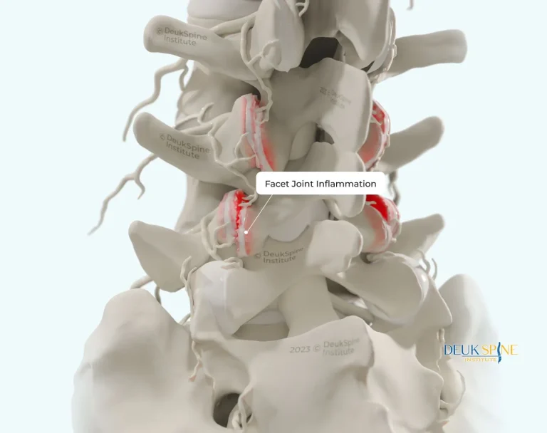 Diagram of a spine showing facet joint inflammation highlighted in red.
