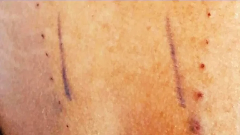 Close-up of a back with two vertical lines and several small red dots beside them.