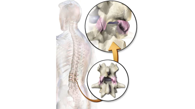 Diagram showing the human spine with close-ups of vertebrae and disc highlighting spinal anatomy.