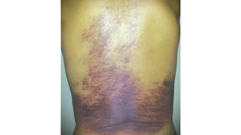 A back with a large, dark bruise covering the lower half.