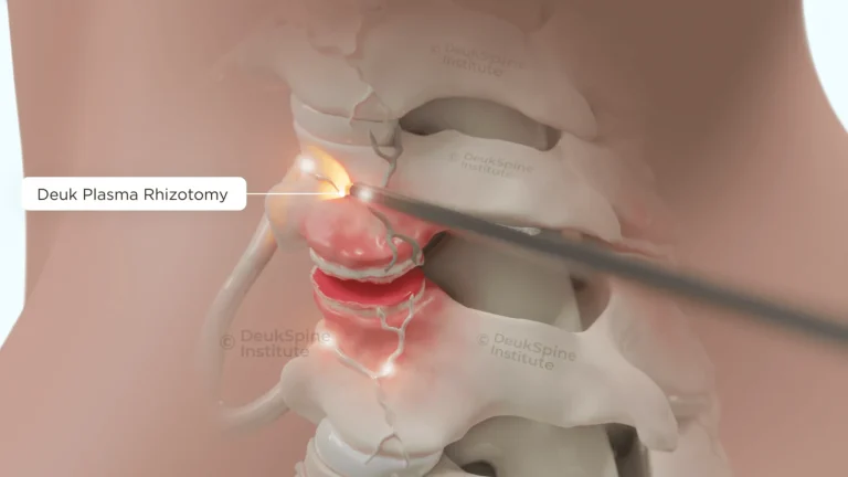 Illustration of Deuk Plasma Rhizotomy procedure on the spine.