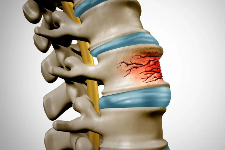 Illustration of a spine with a fracture and redness in one vertebra.