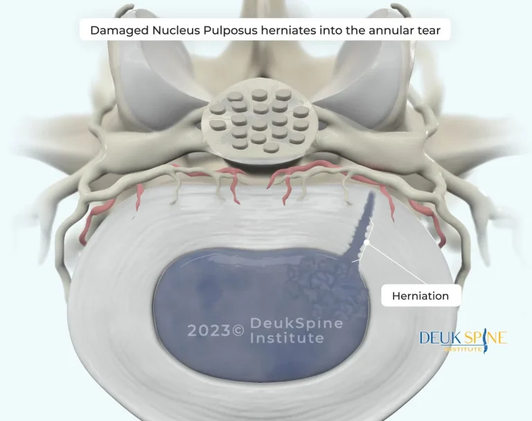 Illustration of nucleus pulposus herniating into an annular tear in a spinal disc.